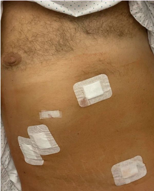 «Дуже схуд»: Потап переніс складну операцію1